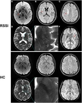 Macular Microvasculature Is Associated With Total Cerebral Small Vessel Disease Burden in Recent Single Subcortical Infarction